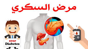 علاج مرض السكر 
