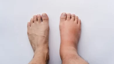 أعراض زيادة الأملاح في الجسم